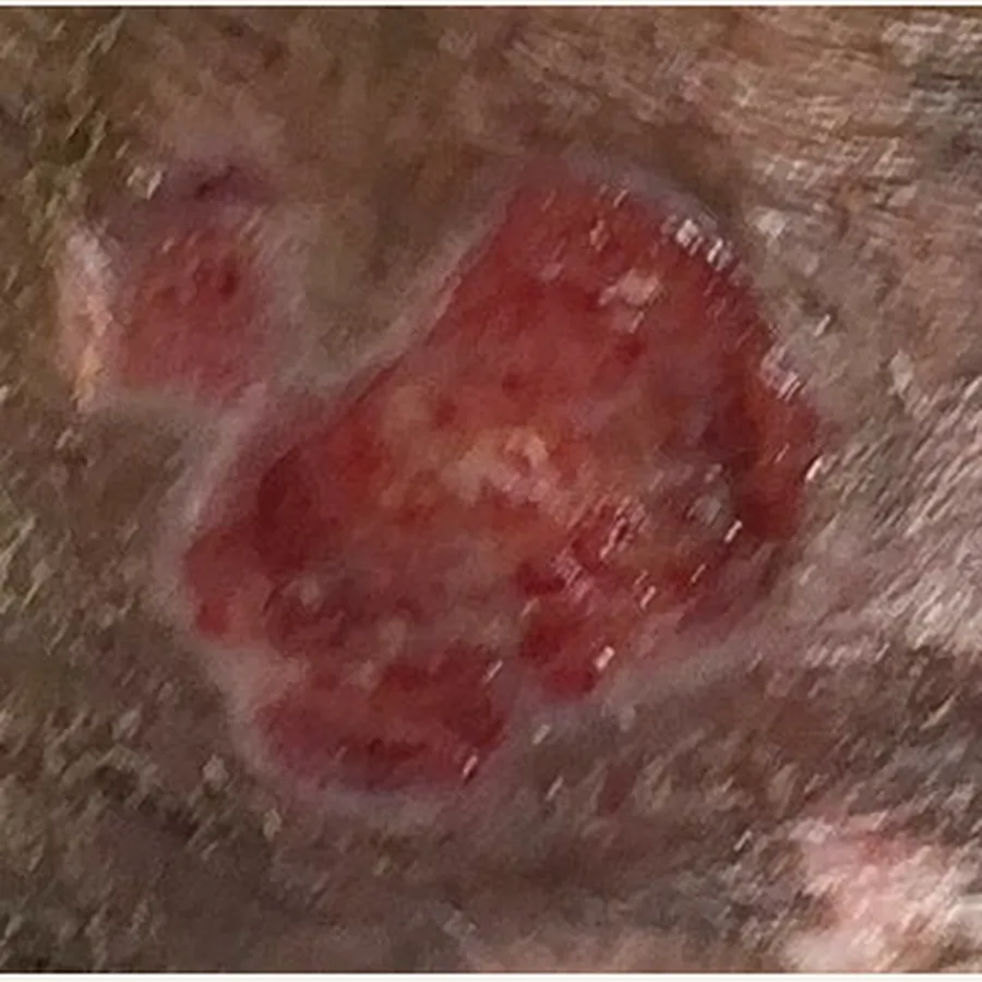 Clinical photograph of a lymphovascular leg wound at visit 4, HKL-88