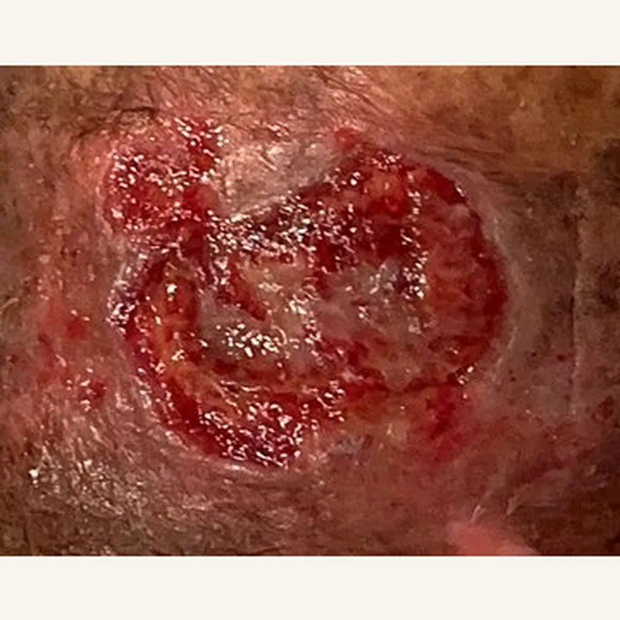 Clinical photograph of a lymphovascular leg wound at visit 5, HKL-88